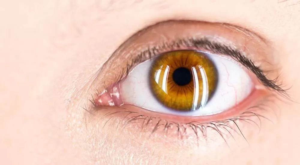 Síndrome do olho seco pode se tornar incapacitante, alerta oftalmologista